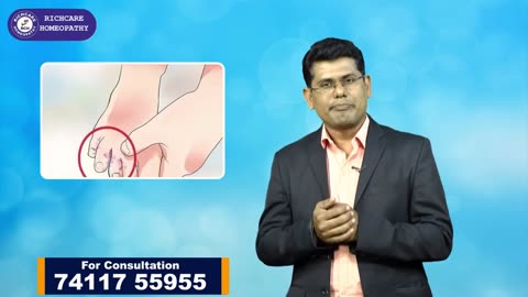 Tinea Treatment in bangalore | Homeopathy treatment | Richcare Homeopathy