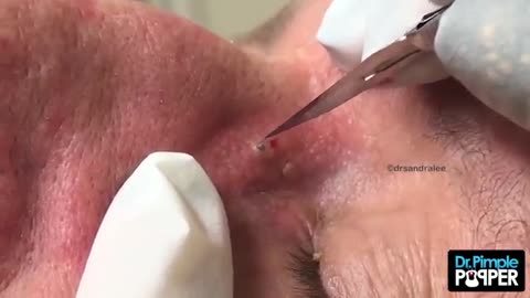 Oh, Blackheads, My Blackheads! A Medley