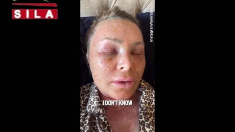 Tamra Judge reveals side effects from cosmetic procedure