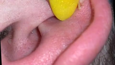 Blackhead Removal - Pimple popping - Acne Treatment - 09 #shorts