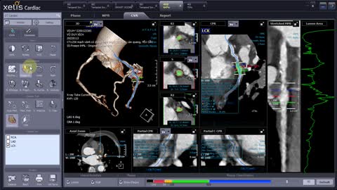 CT Cardiac with Xelis (INFINITT PACS)