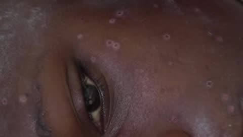 outbreak of Monkey Pox, a hospital in South Kivu, in the Democratic Republic of Congo