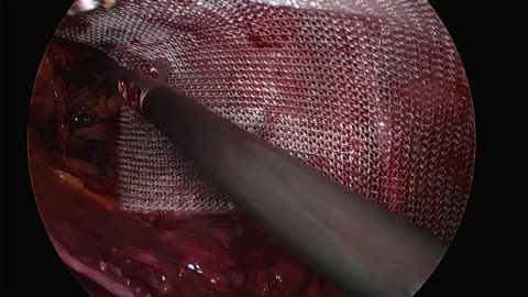 Sithsurgeon - Narrated Laparoscopic Reduction of Strangulated Hernia