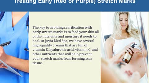 Ways to Remove Stretch Marks After Pregnancy - Juvia Med Spa