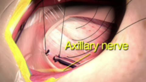 Anterior Approach Shoulder,Patient preparation,Exposure of cephalic Vein,Long Head of Bicep