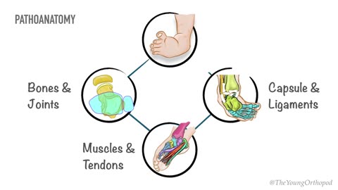 Club Foot Deformity | CTEV | Child | Orthopaedic |Problems