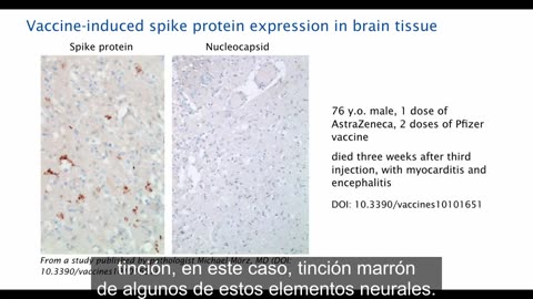 Entrevista final al patólogo Arne Burkhardt: Revelando los graves peligros de las vacunas de ARNm