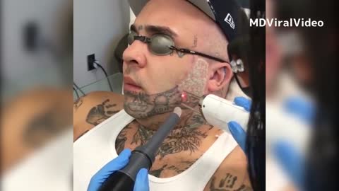 How Face Tattoo Gets Laser Removal