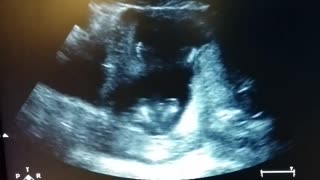 Baby clapping hands in the womb