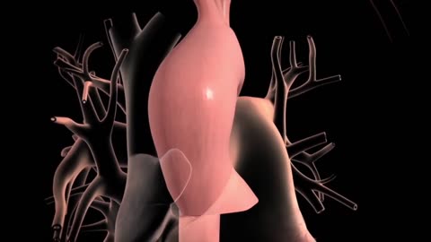 What is an Aortic Aneurysm