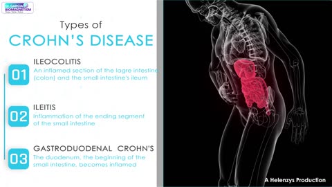 What is Crohn's Disease?