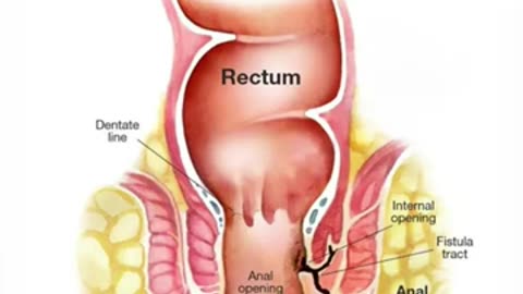 फिस्टुला (भगंदर) का होतो? जाणून घ्या तज्ज्ञांकडून - डॉ सम्राट जानकर
