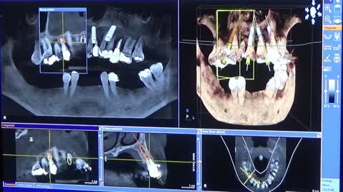 HILLOCK Dental Video Series