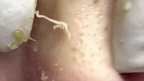 Blackheads & Milia, Big Cystic Acne Blackheads Extraction whiteheads Removal pimple Popping