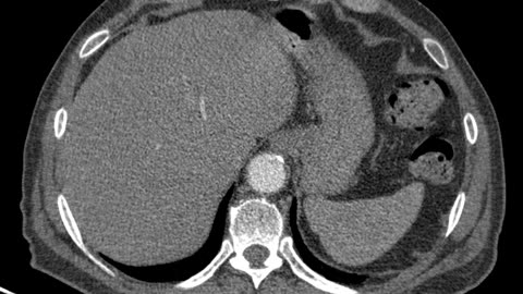 Thoracic CT angiography, axial view