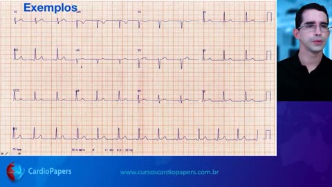 ​Como definir o eixo do QRS no ECG