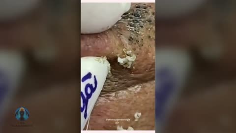 Acne Extraction