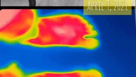 Biomagnetism's effect on atrophied right foot, with photos before, after