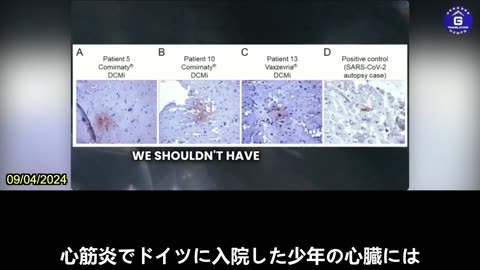 【JP】マッカロー博士 ：多くの研究は新型コロナワクチンが心臓へのダメージを明らかに