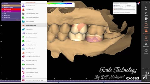 #design #naildesign #dental #dentaldesign #exocadexpert