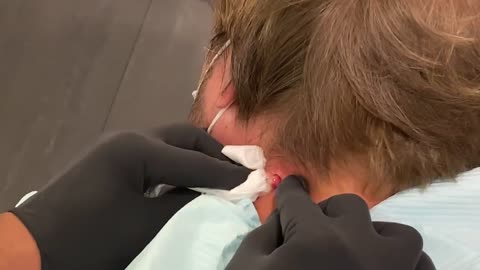 Explosive Neck Cyst