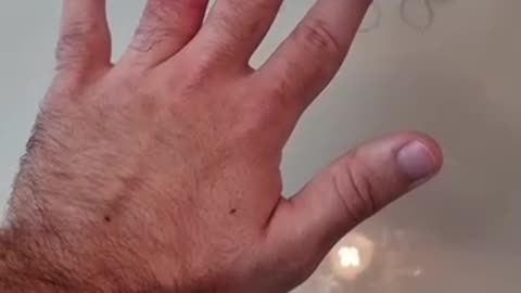 Ring stuck on finger removal