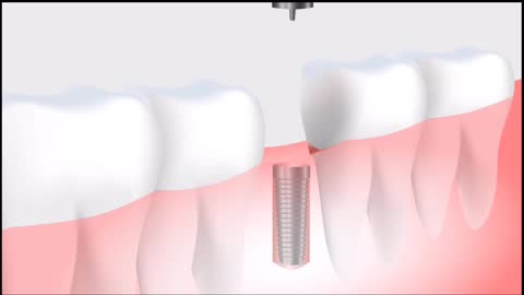 How to do Tooth Implant || how do tooth Implant || H4R