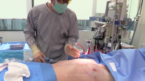 Male Chest Reduction Surgery With Minimal Scarring! - Male Gynecomastia Barrett Plastic Surgery