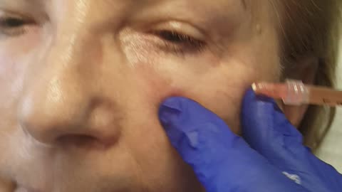 LIVE PRF Under Eye Treatment - Las Vegas Aesthetics