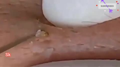 Pimple popper blackheads Removal