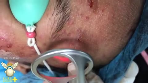 Blackheads on the face