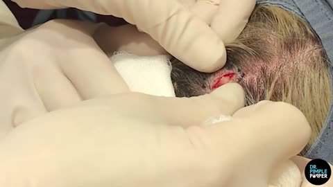 A Crepe Paper Pilar Cyst