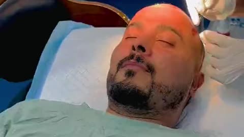 FUE hair transplant