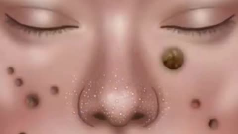 ASMR Treatment blackheads