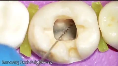 HOW ROOT CANAL & COMPOSITE TREATMENT WORKS