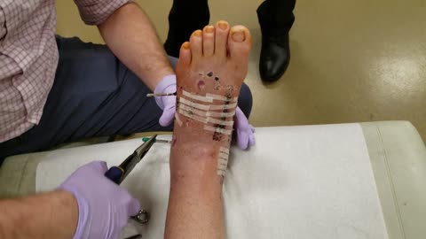 Motorcycle accident injury, Pins getting pulled from multiple fracture foot operation