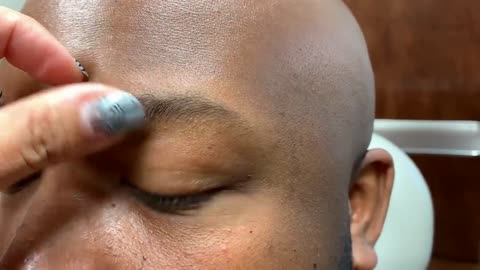 Removing patient third eyeball