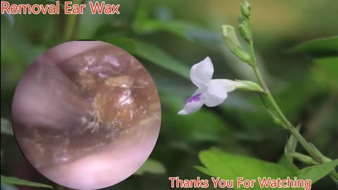 gigantic ear wax removal #15