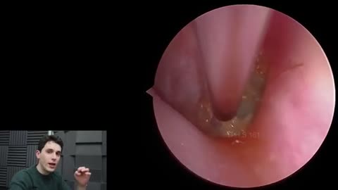 Tympanostomy tube cleaned (eardrum tube)