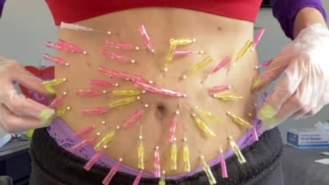 Tummy Mesh And Tightening Using PLLA