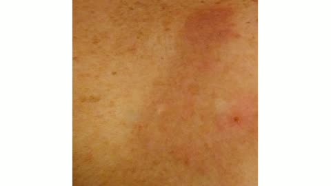 Treating a Giant Basal Cell Carcinoma with Curaderm BEC5