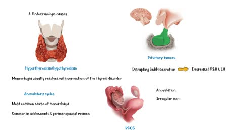 What Causes Heavy Menstrual Bleeding (Menorrhagia) _Causes Of Heavy Menstrual Bleeding