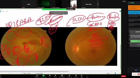 ST5.28 year old Lady with visual loss, BP 160