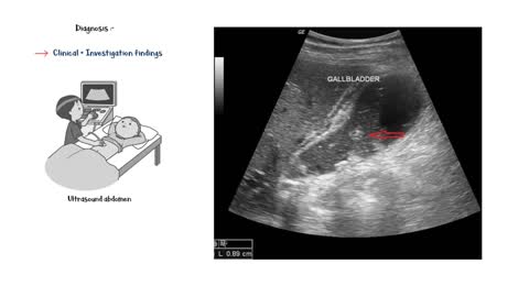 Acute Cholecystitis - Causes, Symptoms, Physical Signs, Diagnosis & Treatment