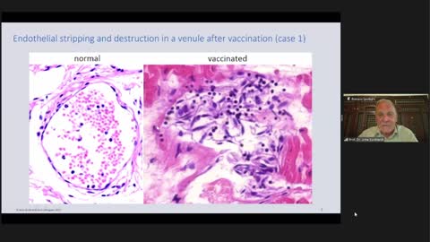 Covid-19 Vaccine Skin Reactions