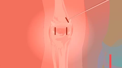 pain management of knee joint that is arthritis or rheumatoid arthritis