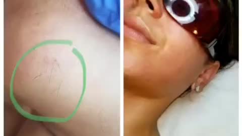 How laser hair removal is done on the chin