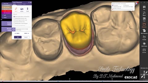 #design #naildesign #dental #dentaldesign #exocadexpert