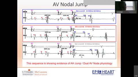 UTHealth EP Heart EP/CV Training Program- AVNRT Presentation