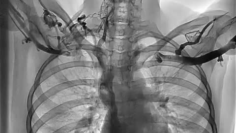 Exploring Venous Thoracic Outlet Syndrome: A Phlebography Study